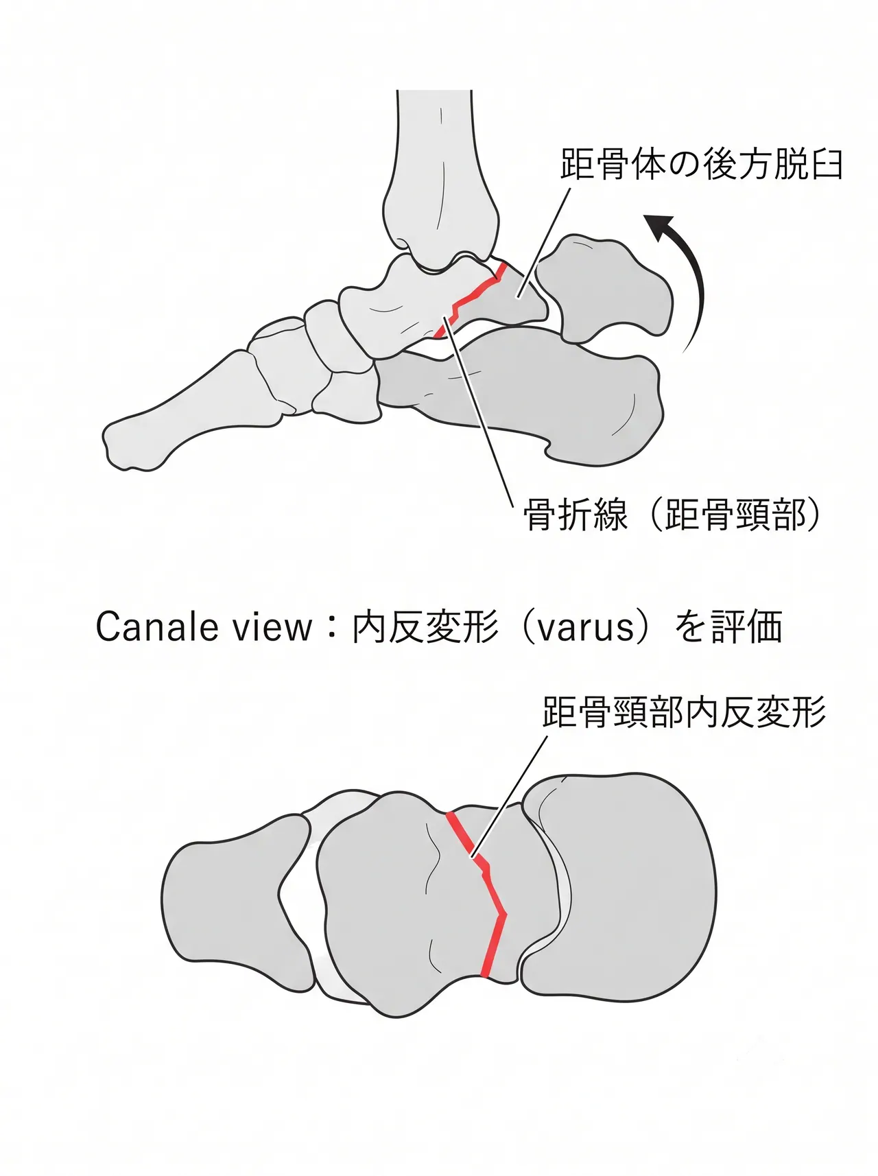 術前X線側面像・Canale view — 距骨頸部骨折線・距骨下関節脱臼の方向・転位量を評価