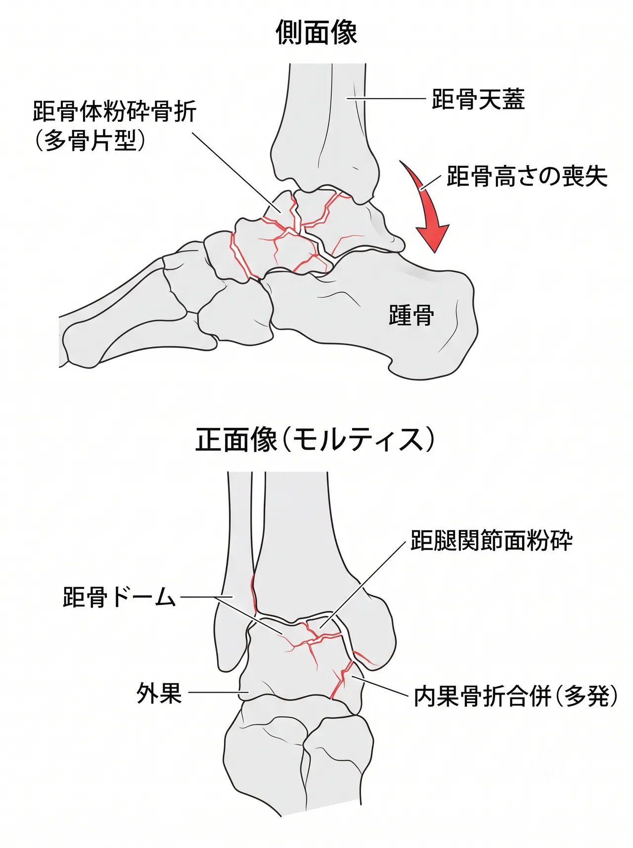 術前X線正面像・側面像・Canale view — 距骨体粉砕骨折・高さ喪失・脱臼方向の評価