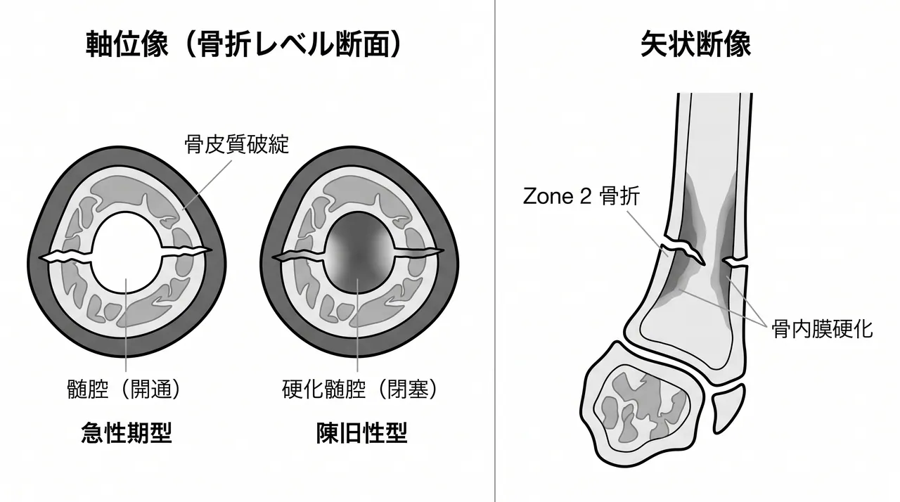 CT矢状断・軸位断 — 骨折線走行・皮質反応・骨髄腔の状態評価