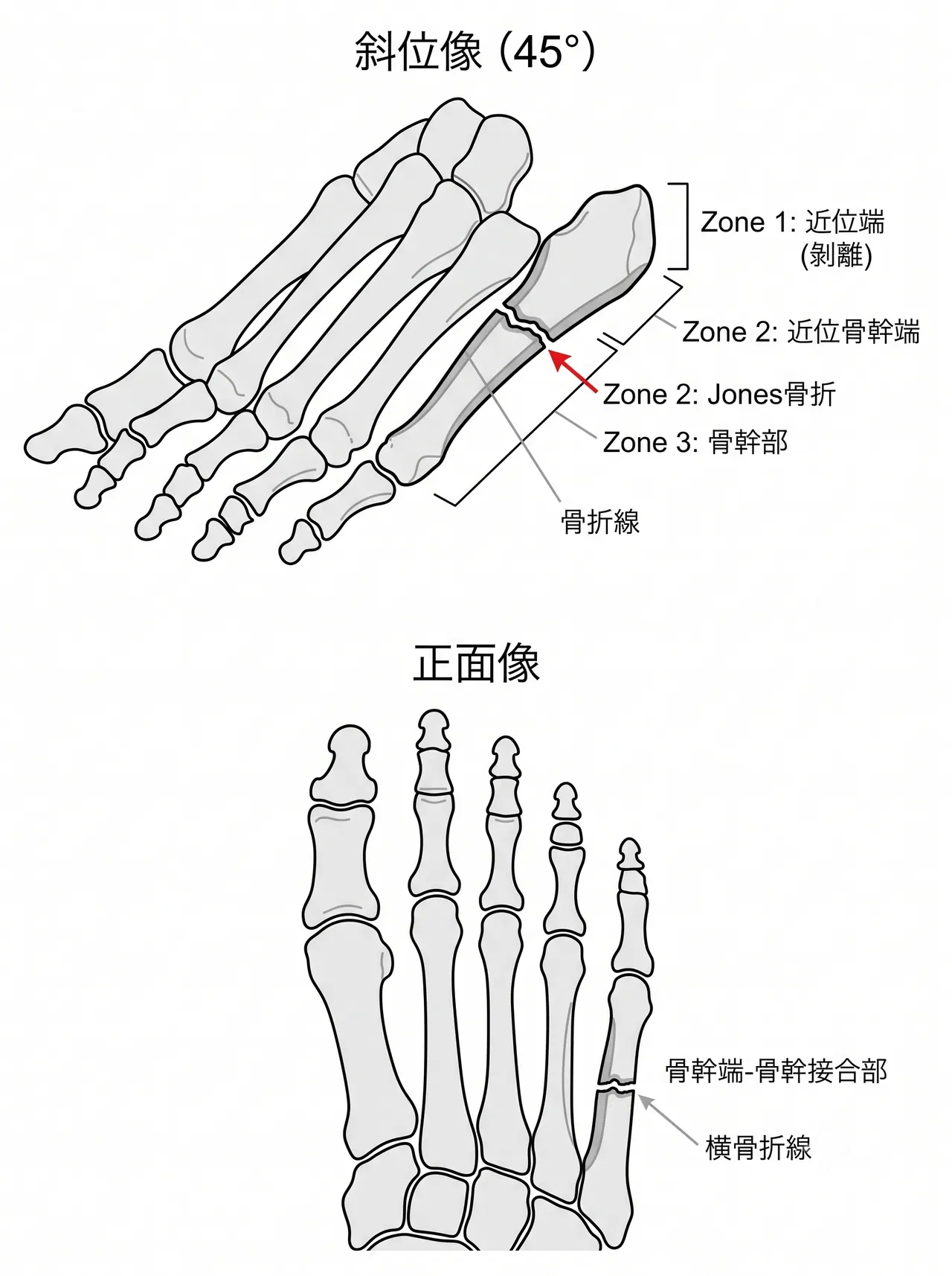 術前X線斜位像・正面像 — Zone 2 骨折線・皮質反応・骨髄腔評価