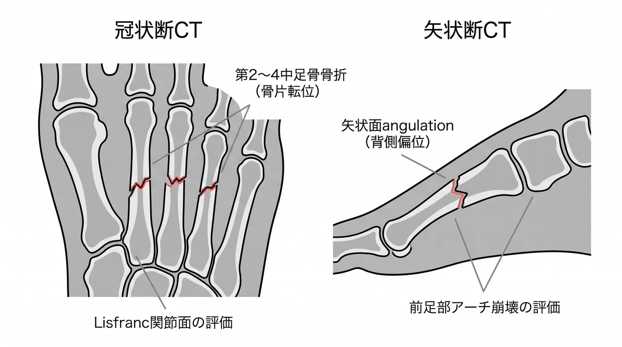 CT冠状断・矢状断 — 多発骨折の骨片数・転位方向・Lisfranc関節面・前足部アーチ崩壊の三次元評価