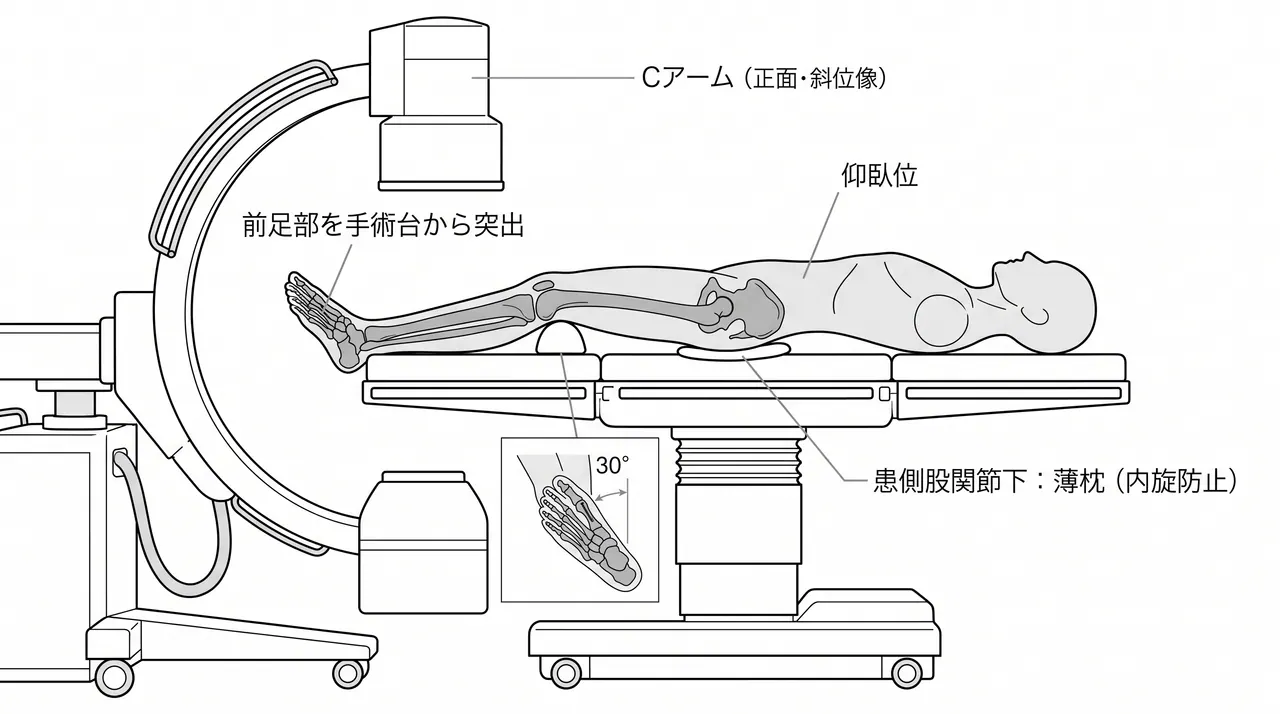 手術体位・C-arm配置 — 仰臥位・前足部突出・背側・斜位透視設定