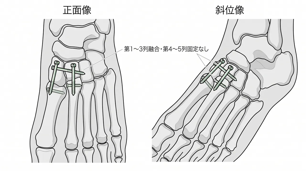 術後X線（正面・斜位）— 整復位とスクリュー位置確認