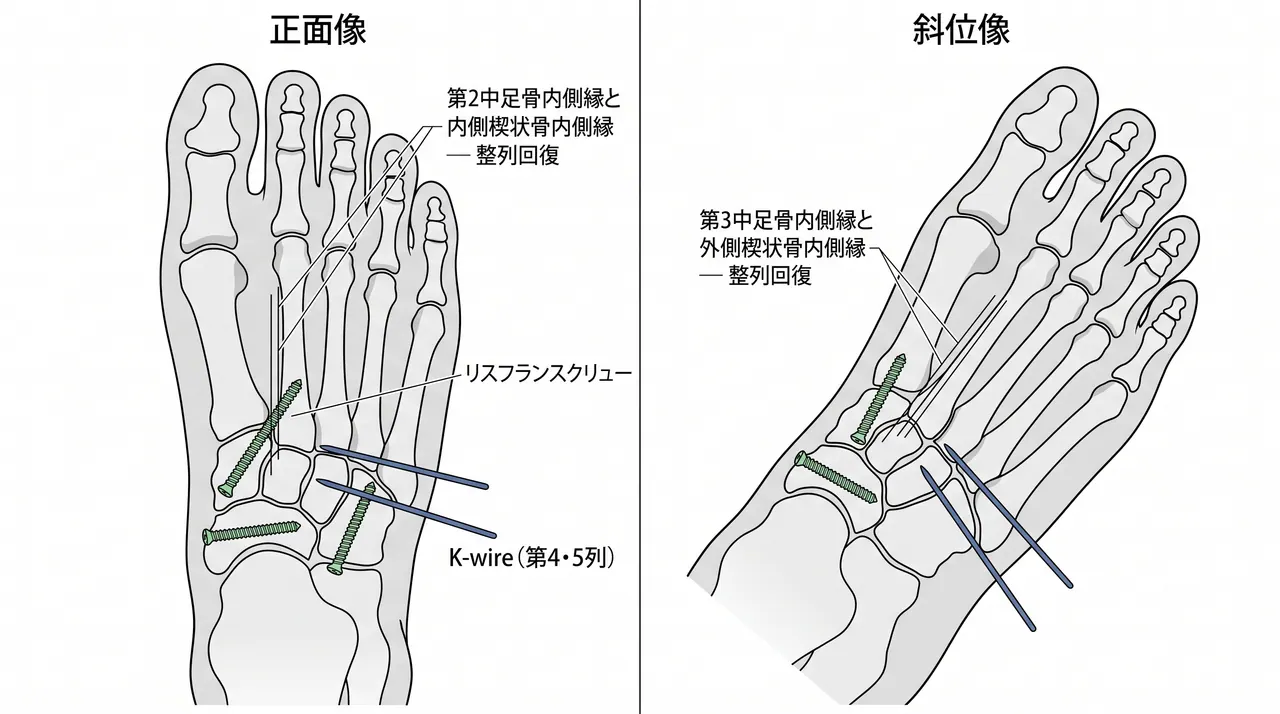 術後X線正面像・斜位像 — リスフラン関節ORIF後の整復位・スクリュー位置・K-wire位置確認