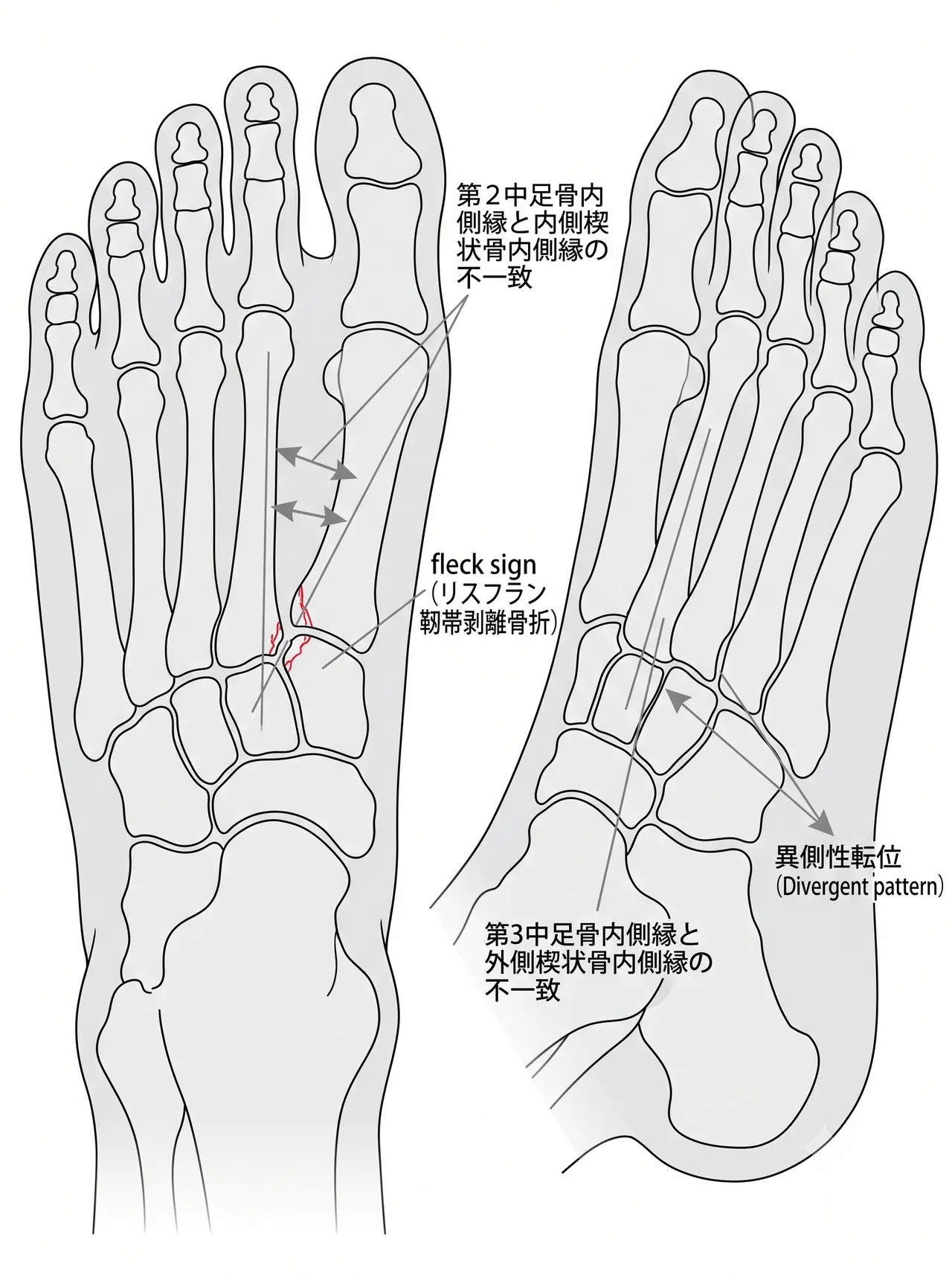 術前X線正面像・斜位像（第2中足骨基部内外側の不一致・転位量の評価）