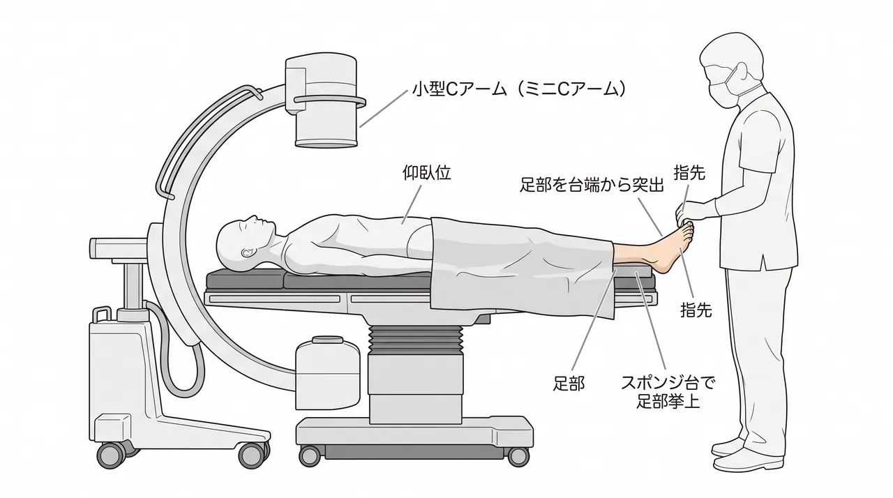 手術体位 — 仰臥位・足部末端突出・小型Cアーム配置