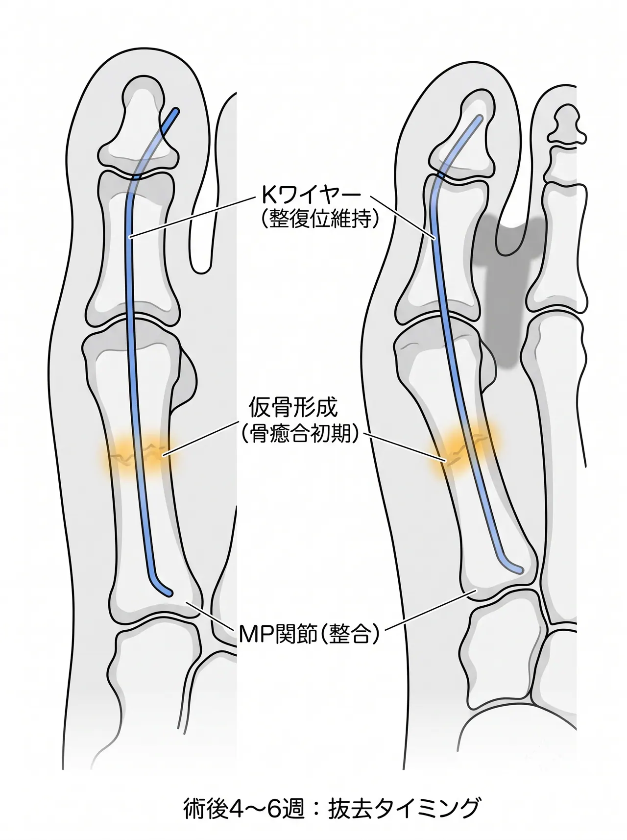 術後X線正面・斜位像 — Kワイヤー位置・整復位・骨癒合評価