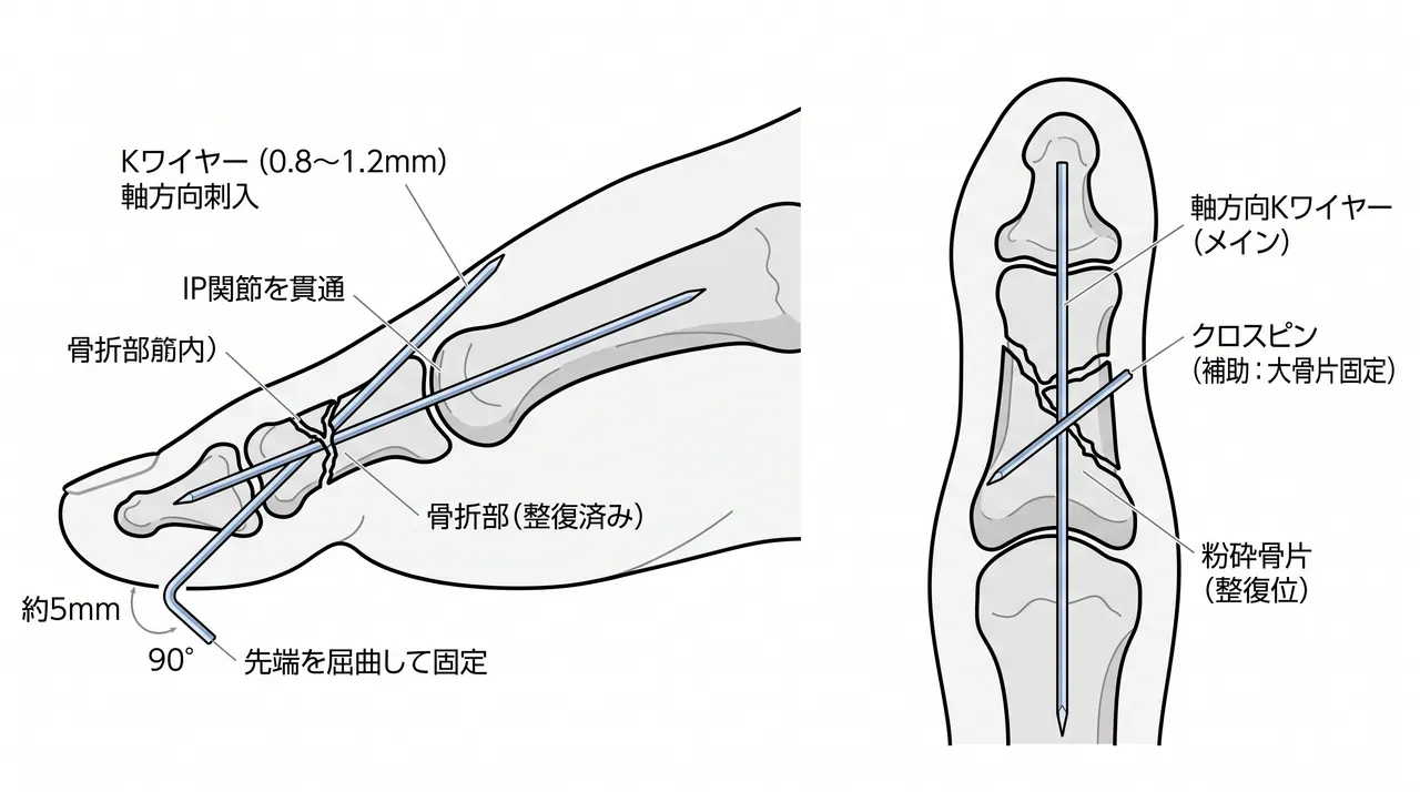 Kワイヤー固定手技 — 軸方向刺入と粉砕骨片の把持
