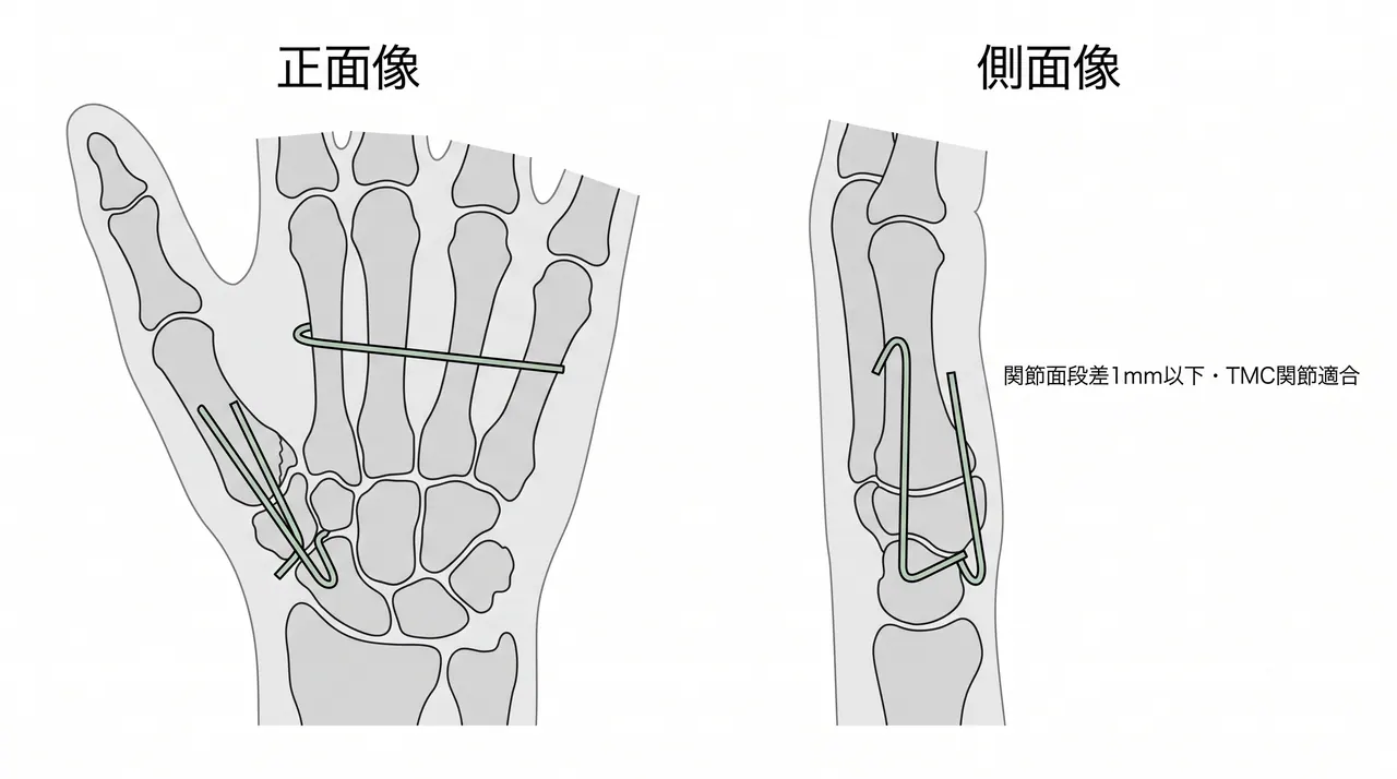 術後X線（AP / Lateral）— TMC関節適合・整復位・インプラント位置の確認