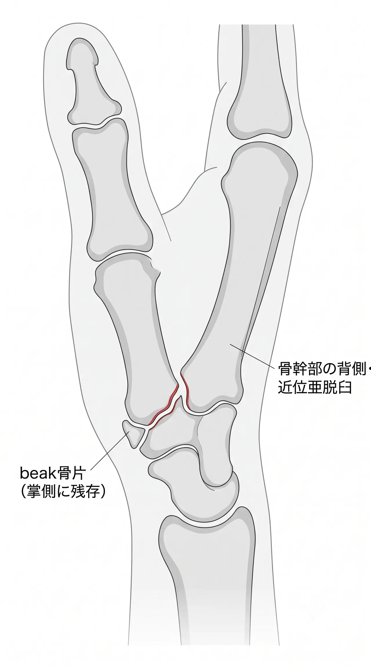 X線 — 母指側面（true lateral）像