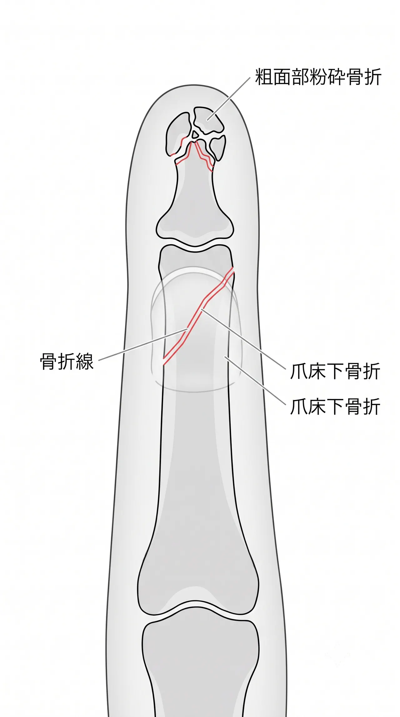 X線正面像 — 骨折線・粗面部粉砕・爪床下骨折の確認