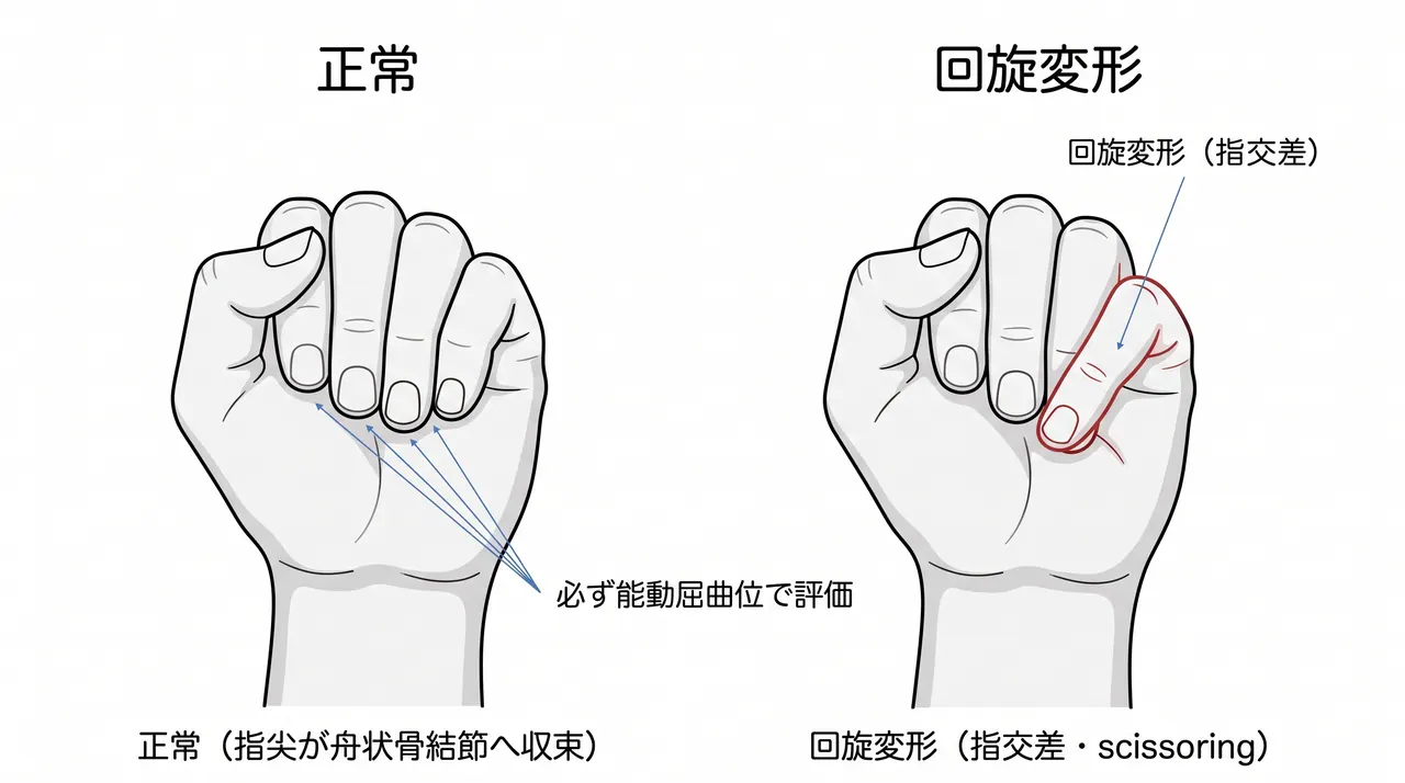 回旋変形の評価 — 屈曲時の指交差（scissoring）と指尖収束（cascade）の確認