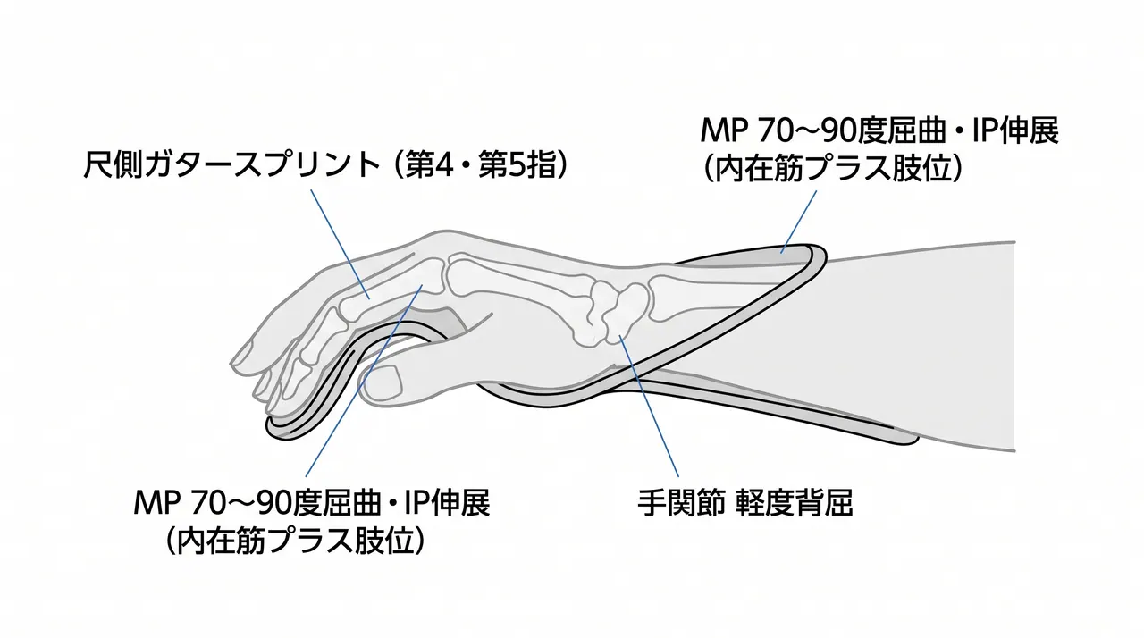 外固定 — 尺側ガタースプリント（内在筋プラス肢位：MP 70〜90度屈曲・IP伸展）