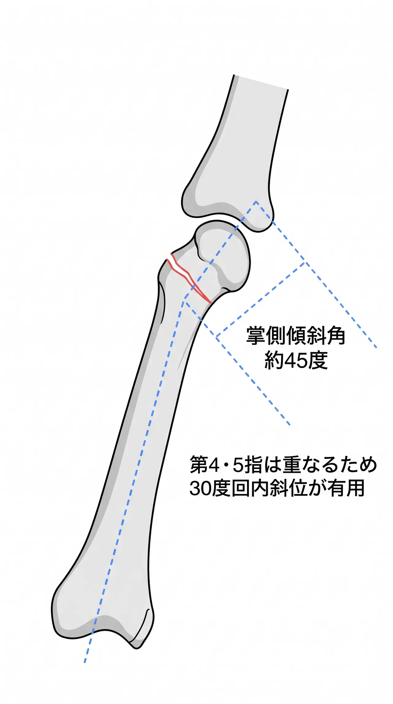 X線側面／斜位像 — 掌側傾斜角の計測