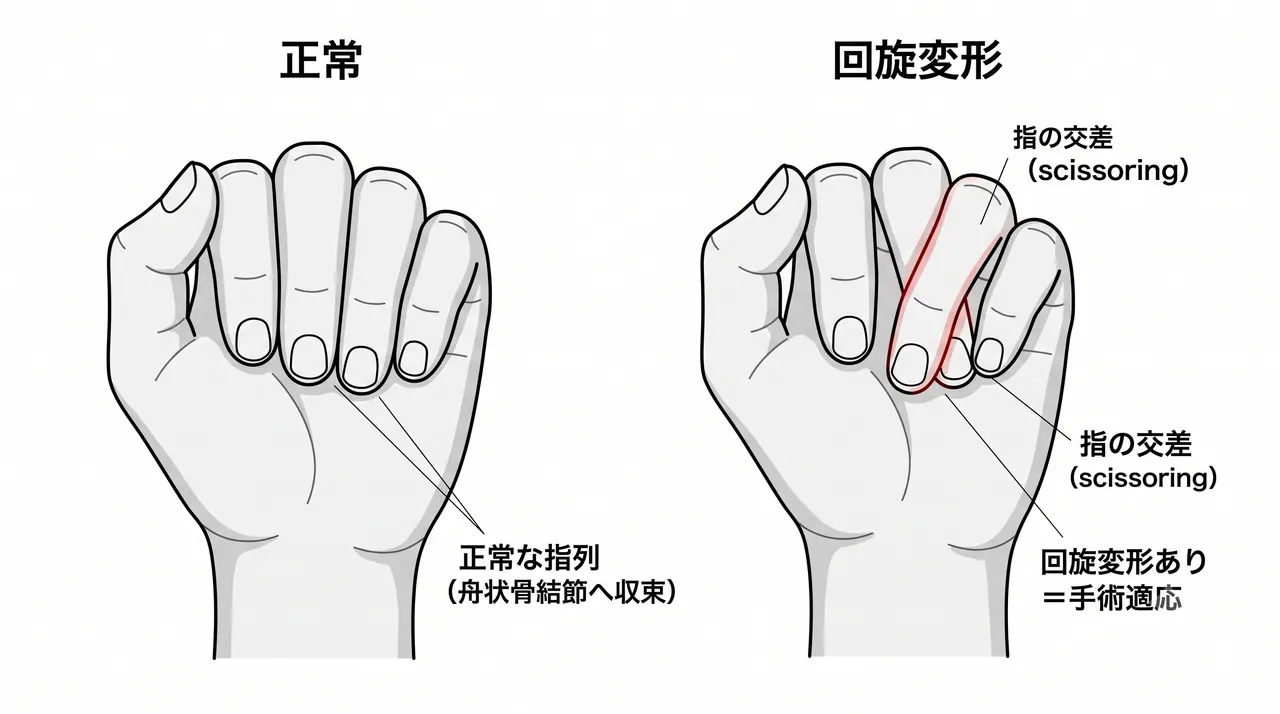 回旋変形の臨床評価 — 屈曲時のscissoring／指列の確認