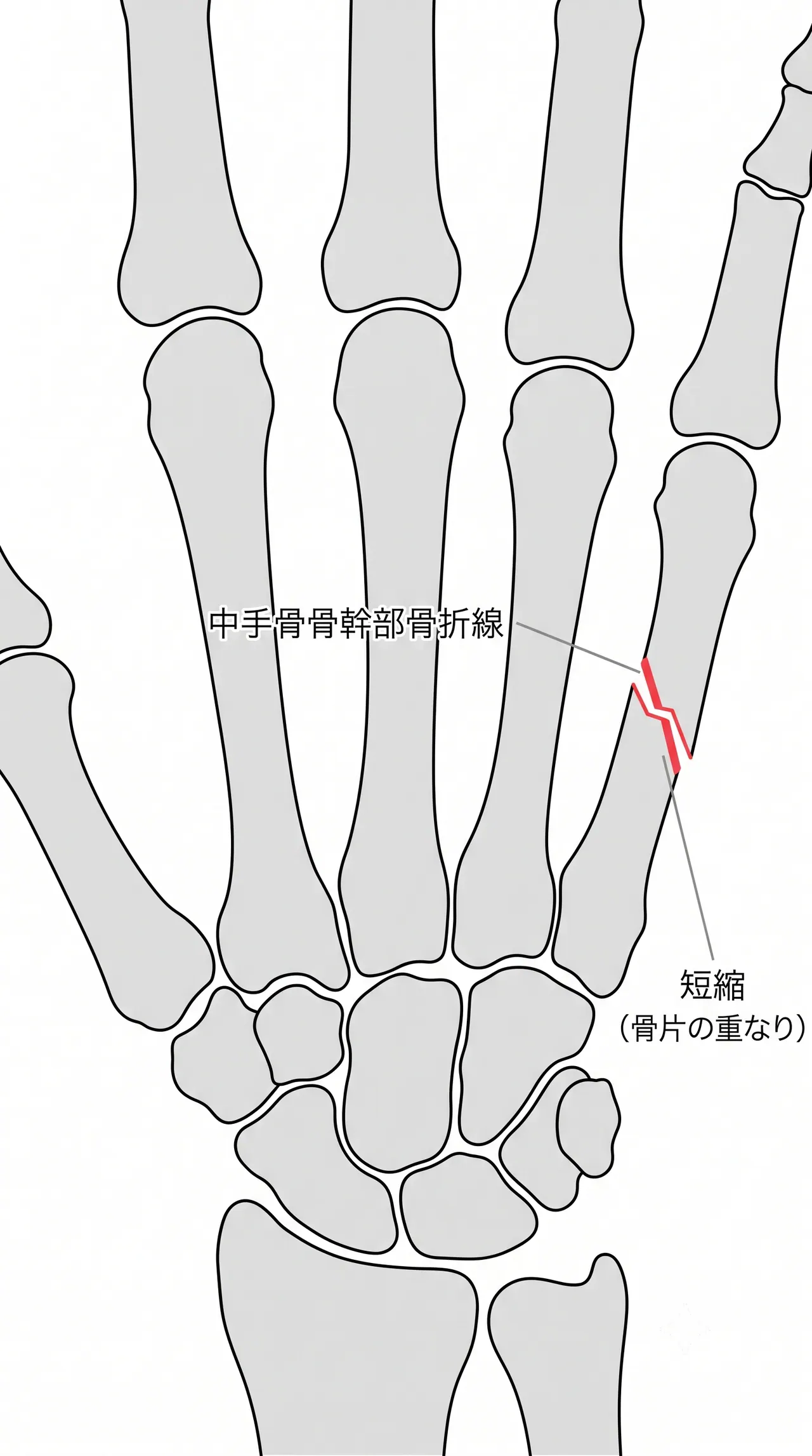 X線正面像 — 骨折線・角状変形・短縮の評価