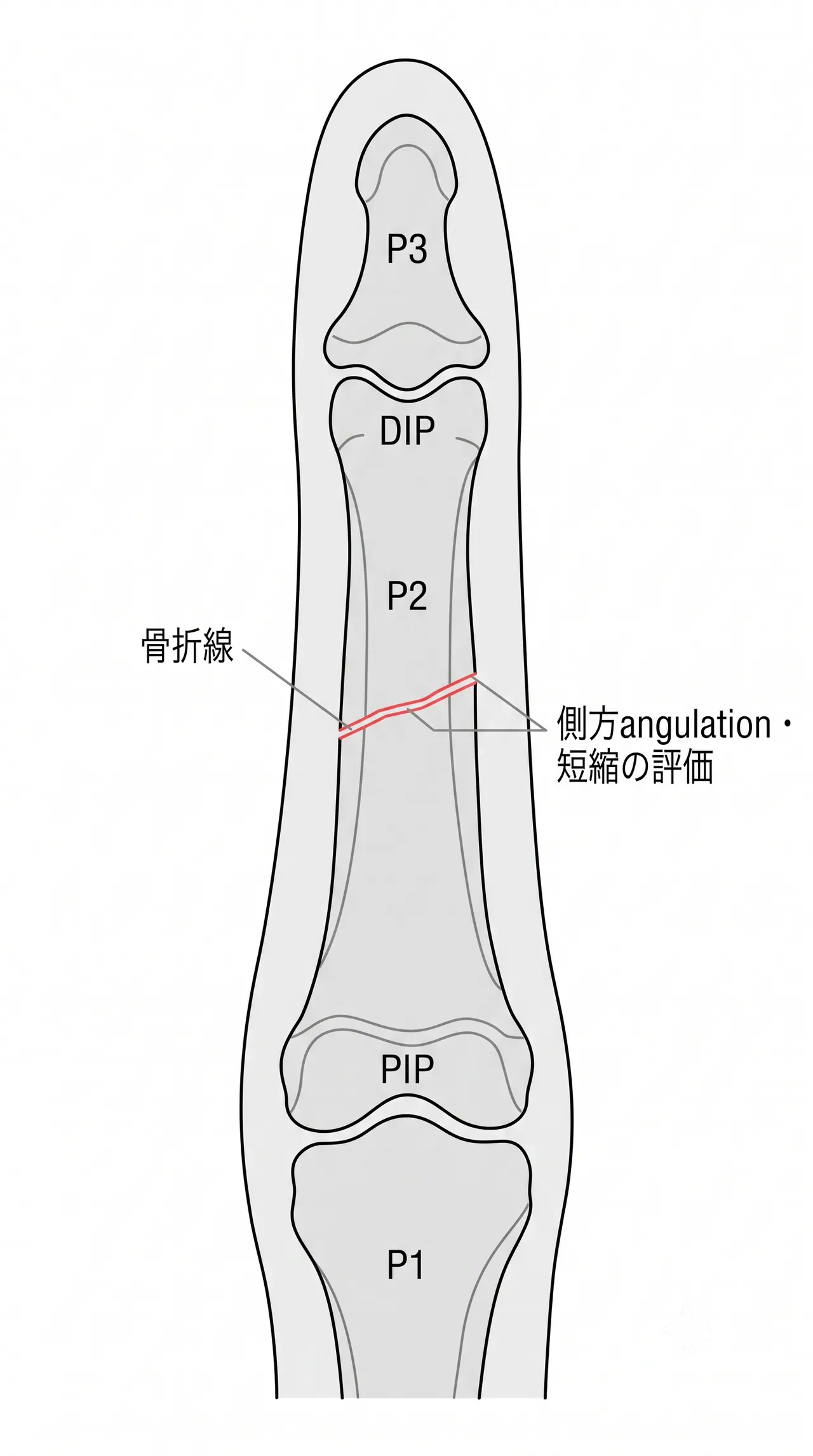 X線正面像 — 骨折線・angulation・短縮・関節面の評価