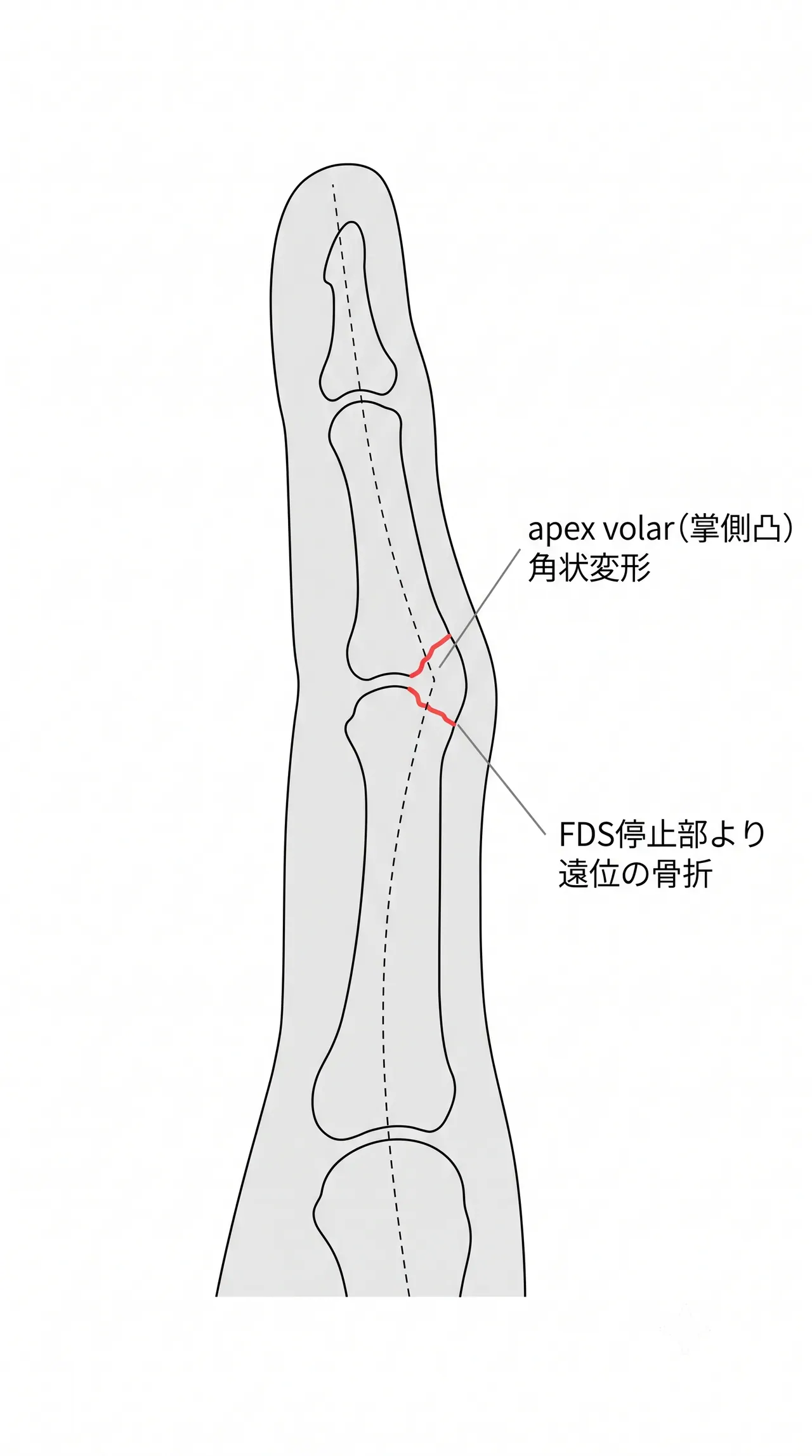 X線側面像（真の側面・単指分離撮影）— apex方向とPIP整合性の確認