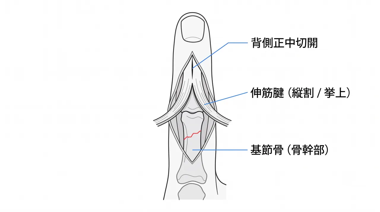 アプローチ — 背側正中切開と伸筋腱の展開