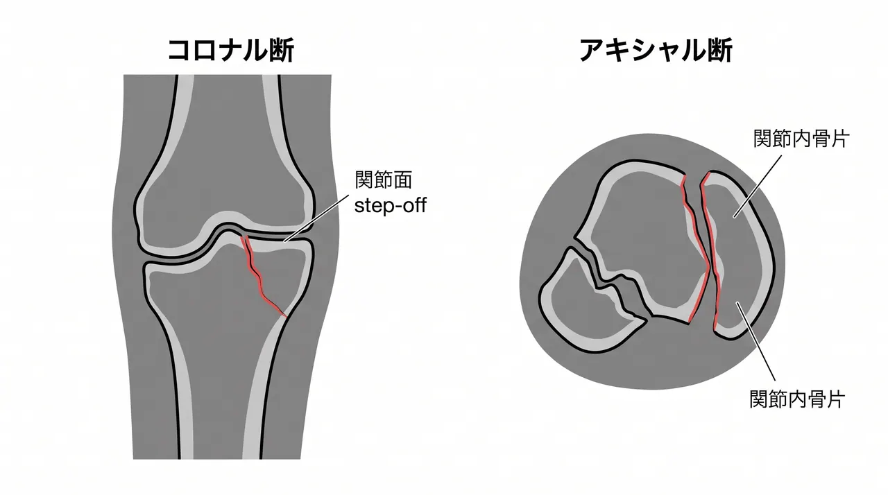 CT — 関節内骨折・顆部骨折の関節面転位評価
