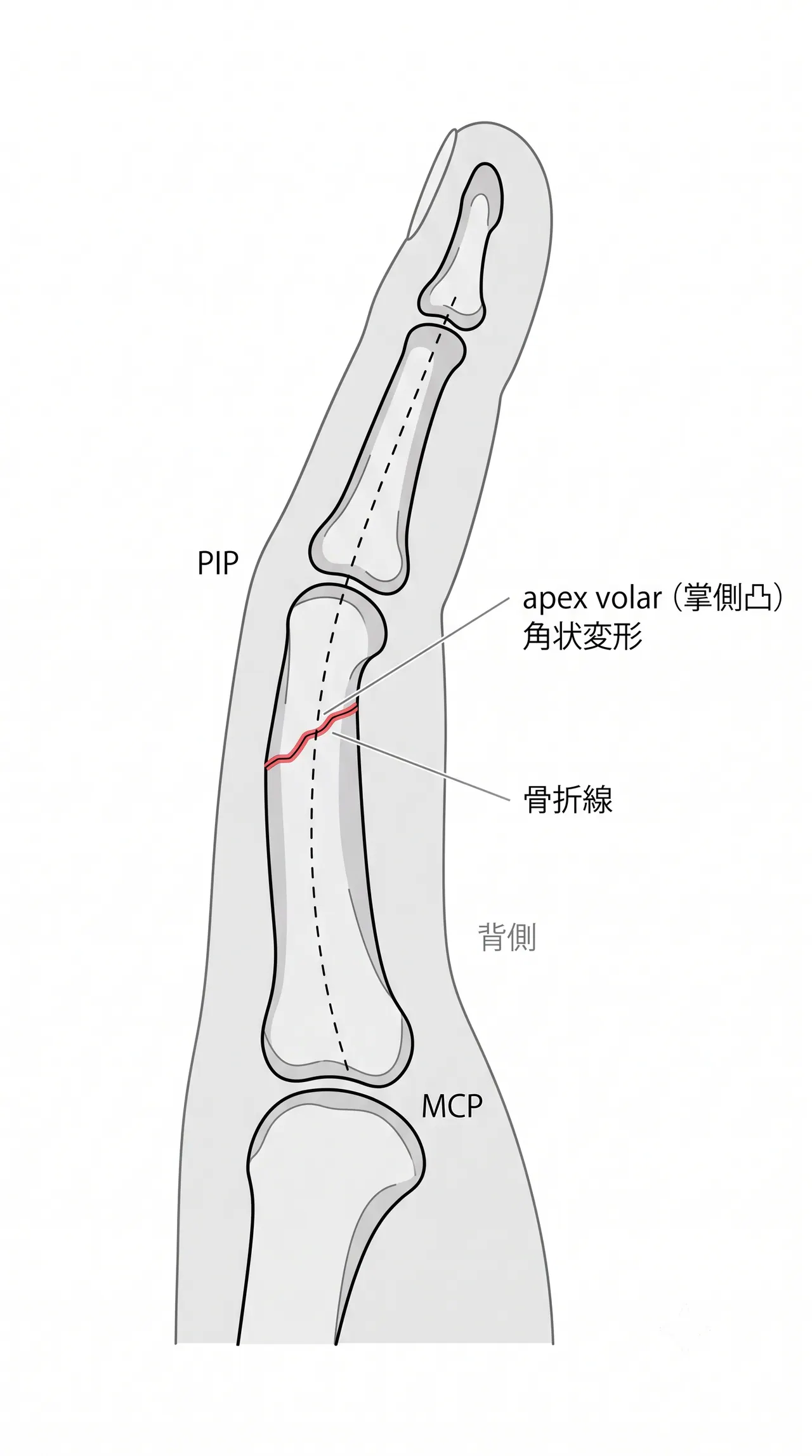 X線側面像（lateral）— apex volar 角状変形の評価