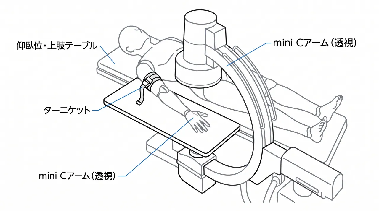 手術体位・手術台セットアップ（仰臥位・上肢テーブル）