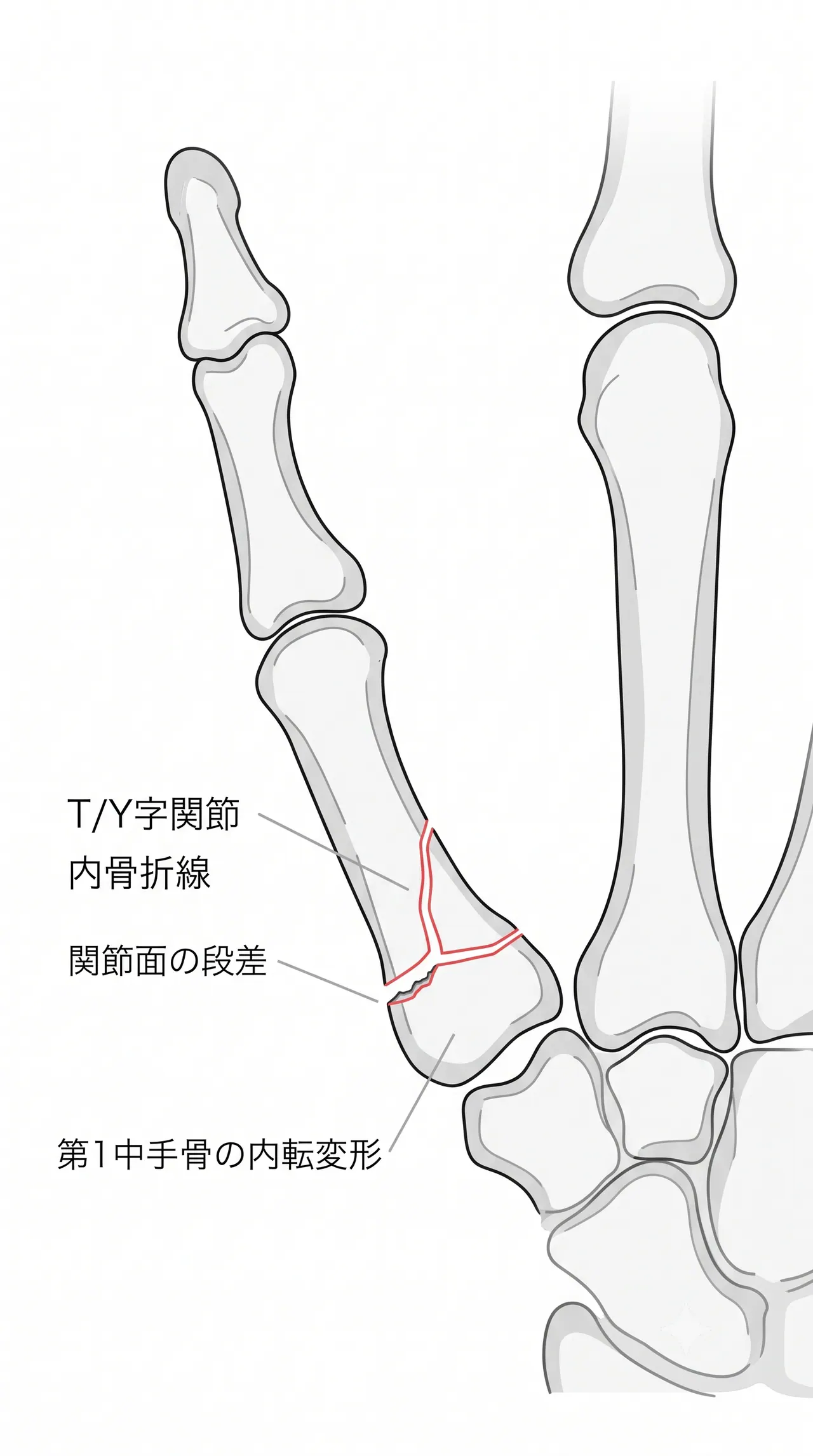 X線正面像 — 関節面の分割・段差・中手骨内転の確認