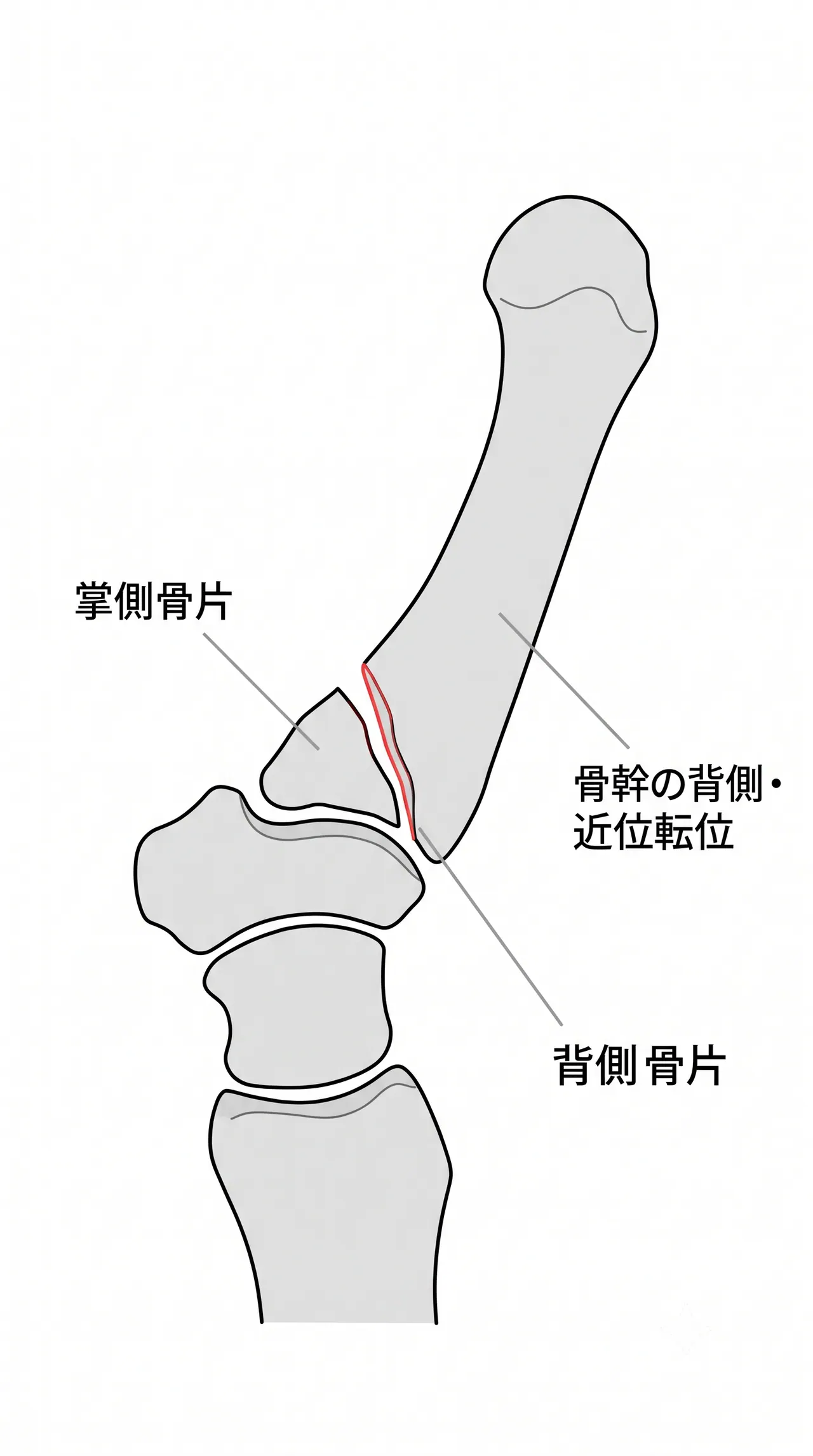 X線側面像 — 掌側・背側骨片の転位評価