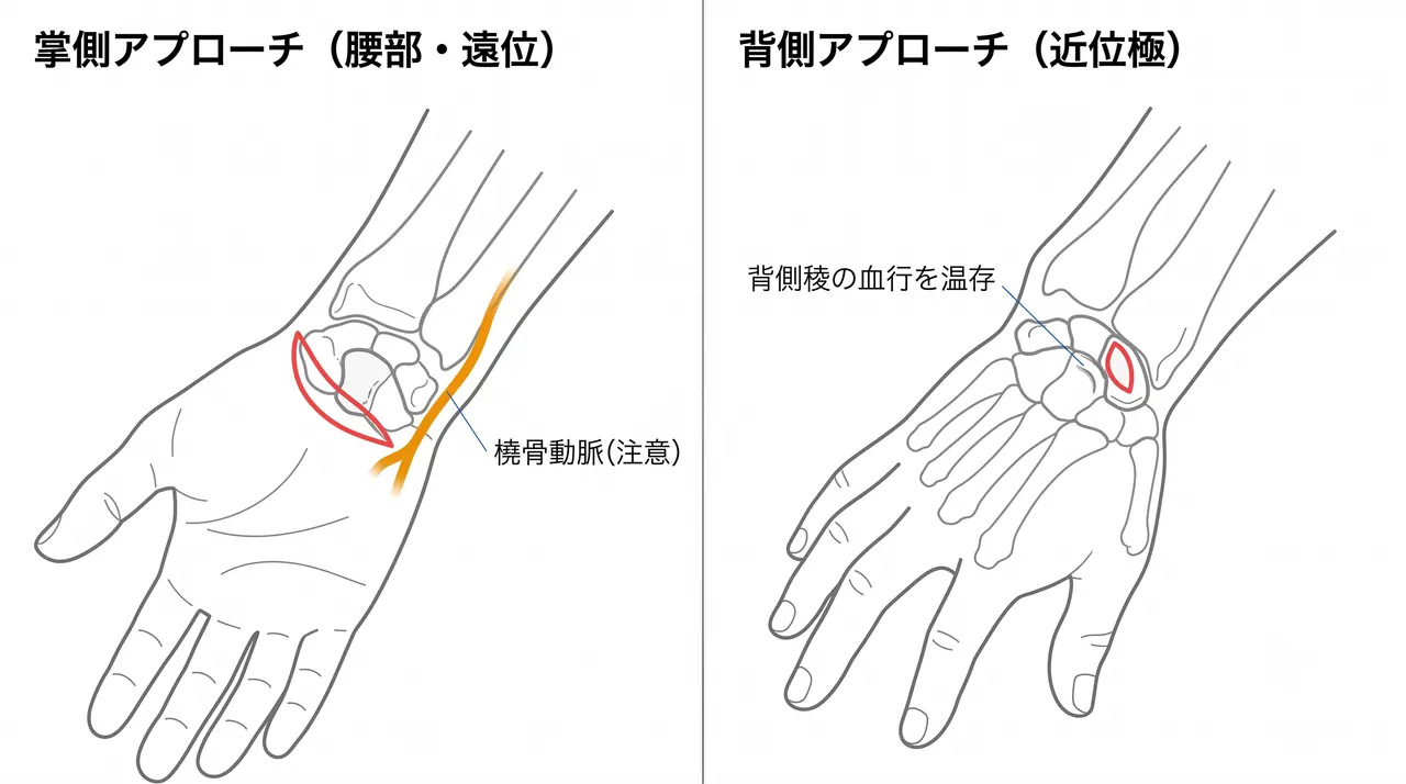 アプローチ選択 — 掌側（腰部・遠位）と背側（近位極）の皮切と展開