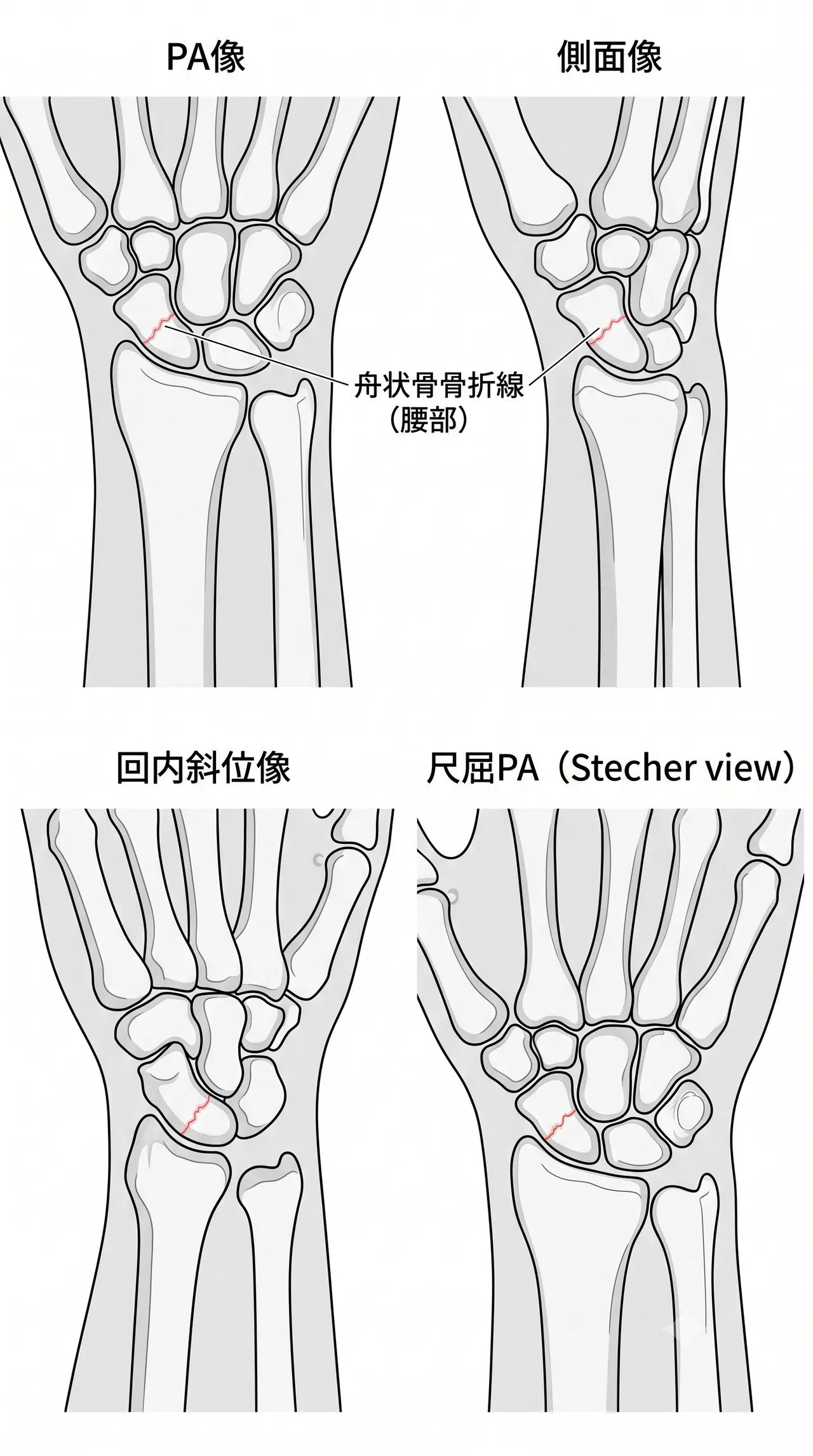 X線 舟状骨4方向撮影（PA・側面・回内斜位・尺屈PA/Stecher view）