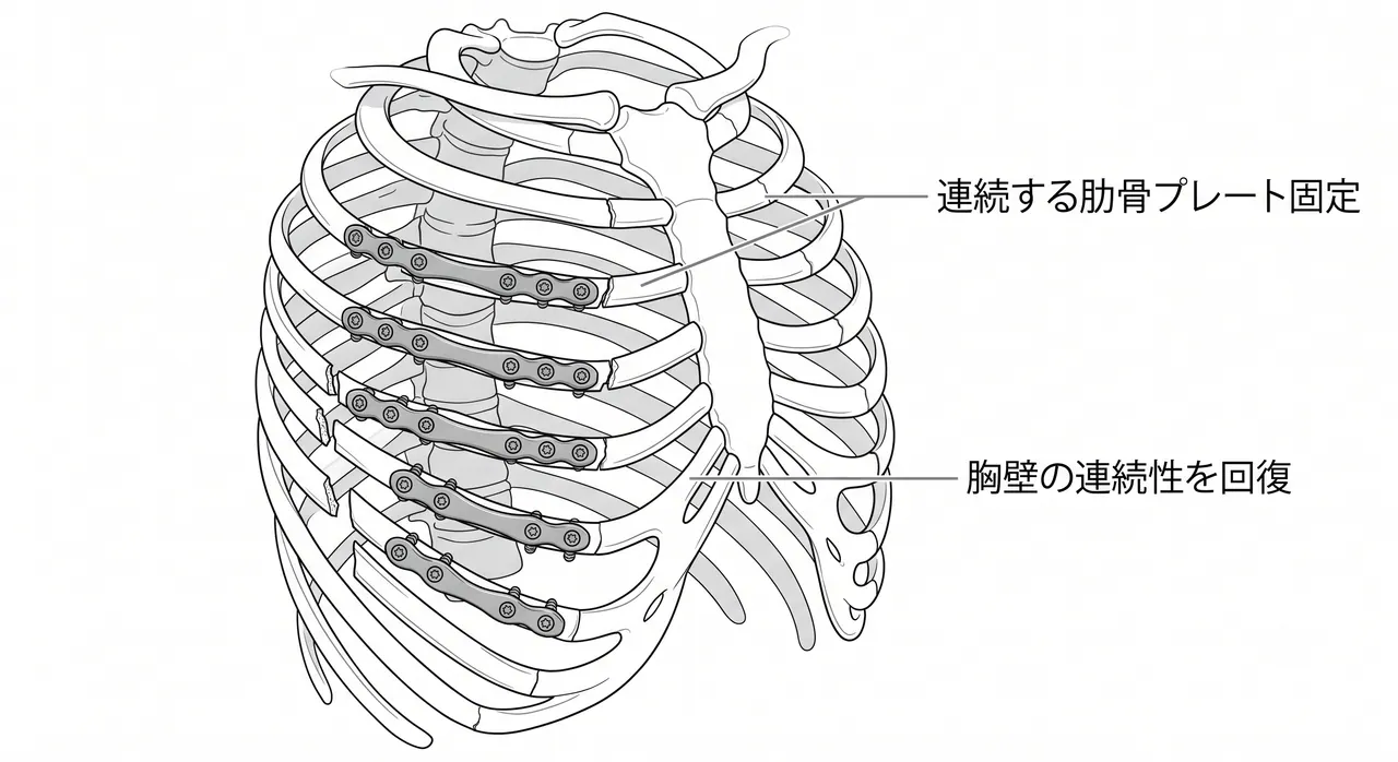 術中所見 — 肋骨の整復とプレート設置