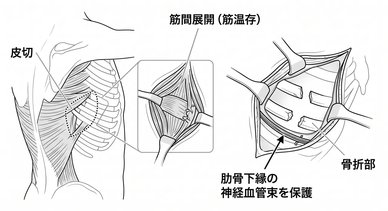 アプローチ解剖図 — 皮膚切開線・筋層（広背筋／前鋸筋）の剥離層