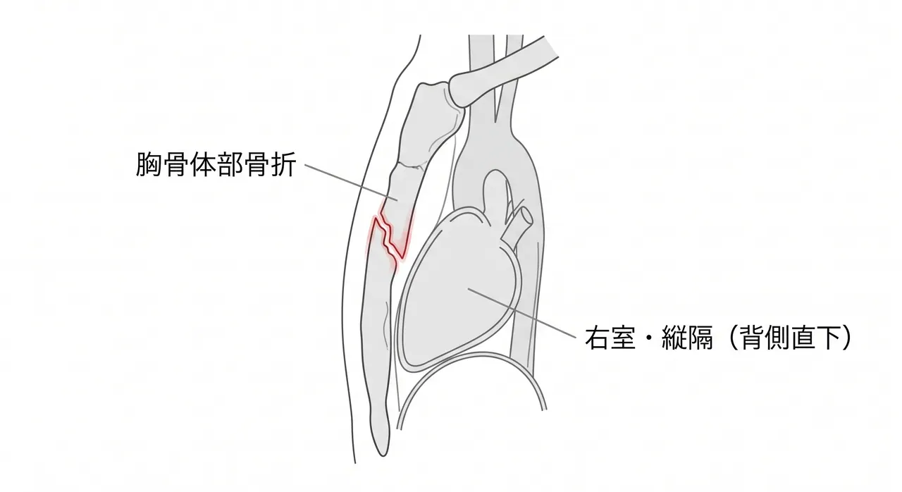 CT矢状断 — 骨折線・転位・overlap の評価、胸腔内合併損傷の同時評価