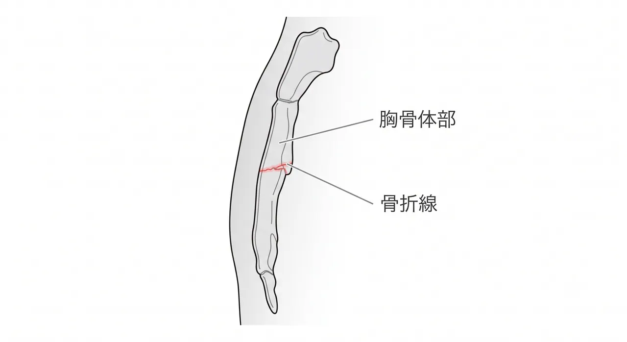 胸部X線 側面像 — 胸骨骨折の描出は側面像が正面像より鋭敏