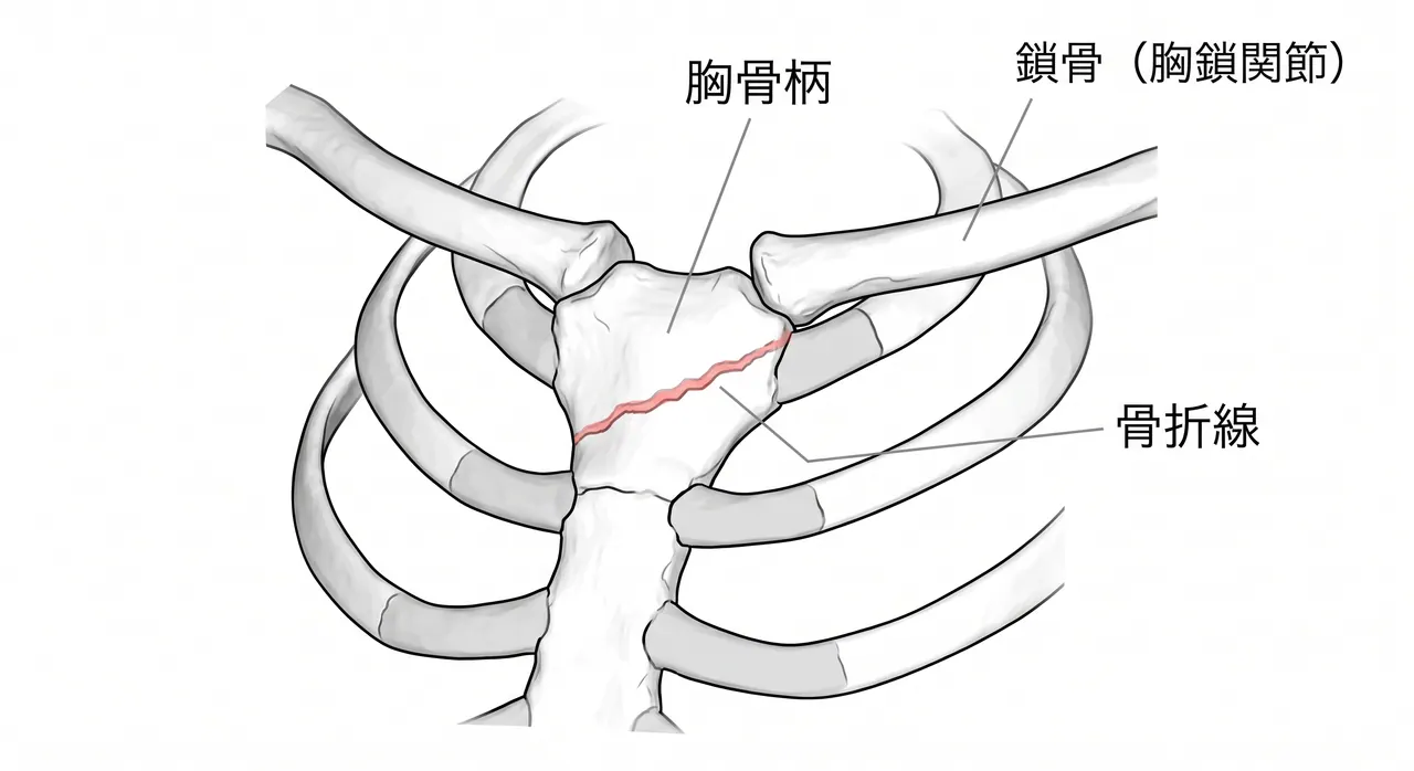 胸部CT 3D再構成 — 胸骨全体形態と随伴肋骨骨折の把握