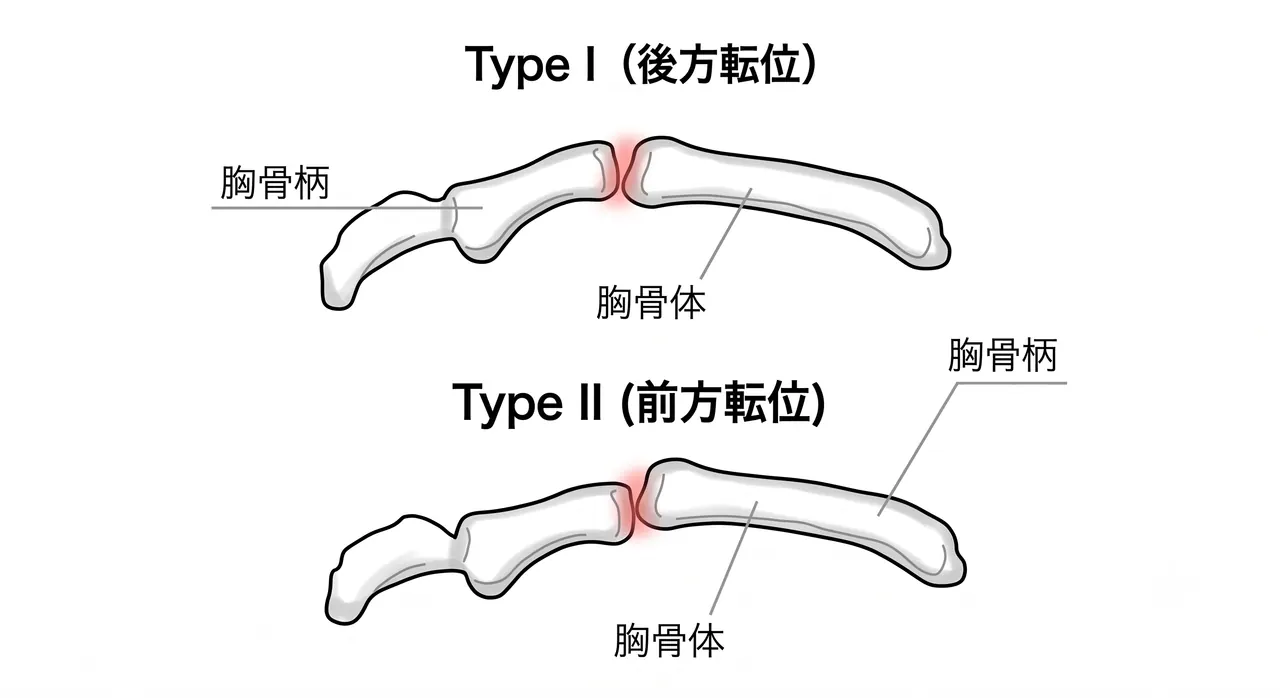 胸部側面X線 — 胸骨柄骨折・胸骨柄体関節転位の評価
