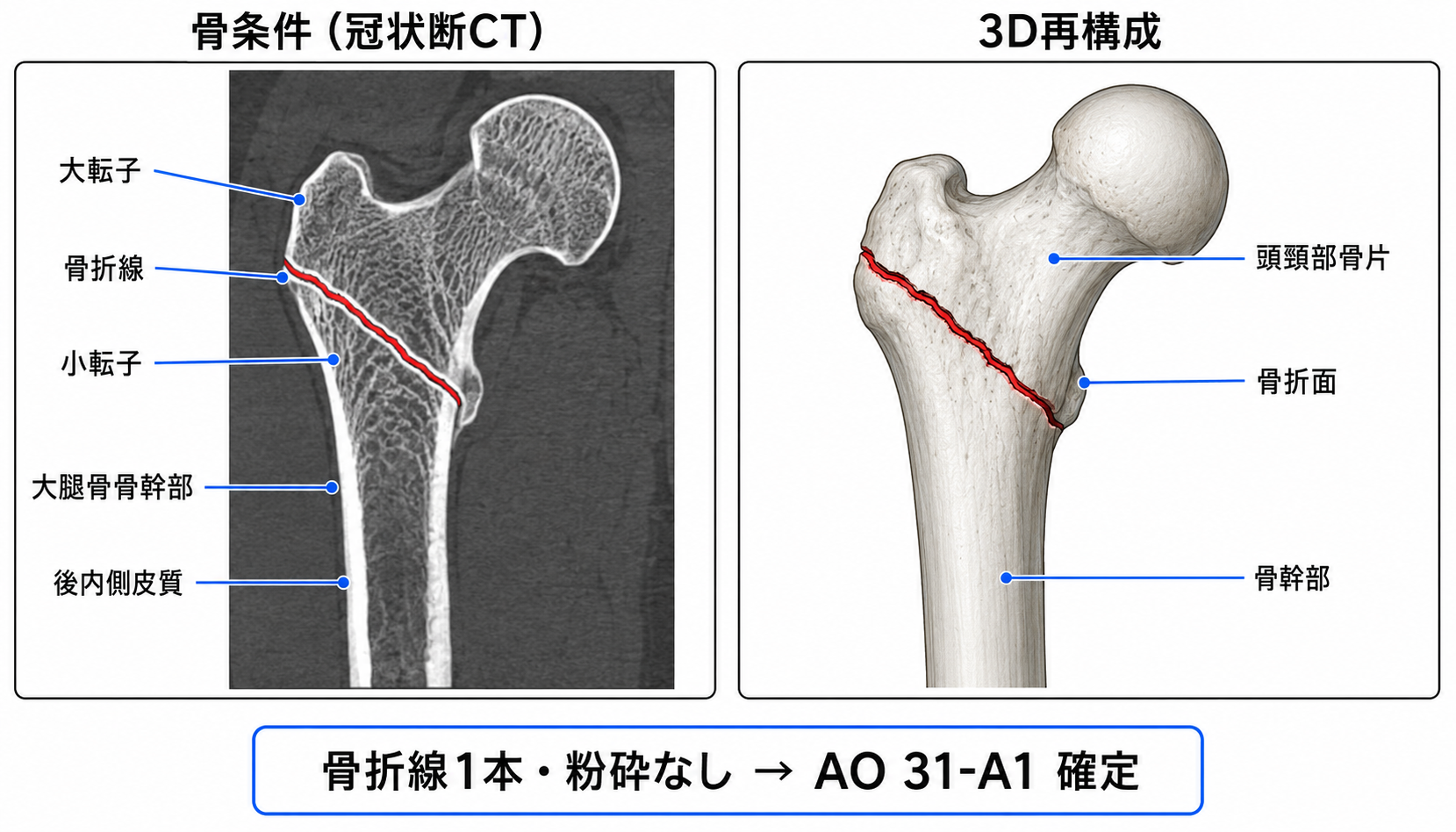 CT冠状断（骨条件 + 3D再構成）
