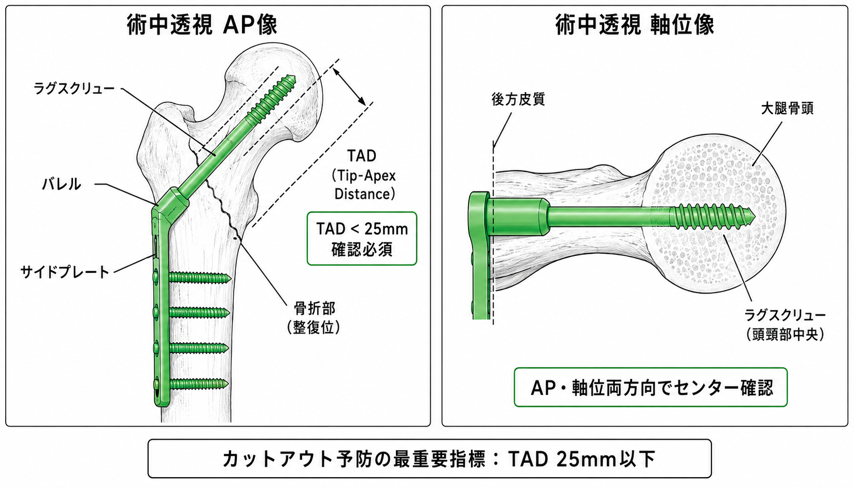 術中透視像 — 整復・インプラント設置確認のポイント