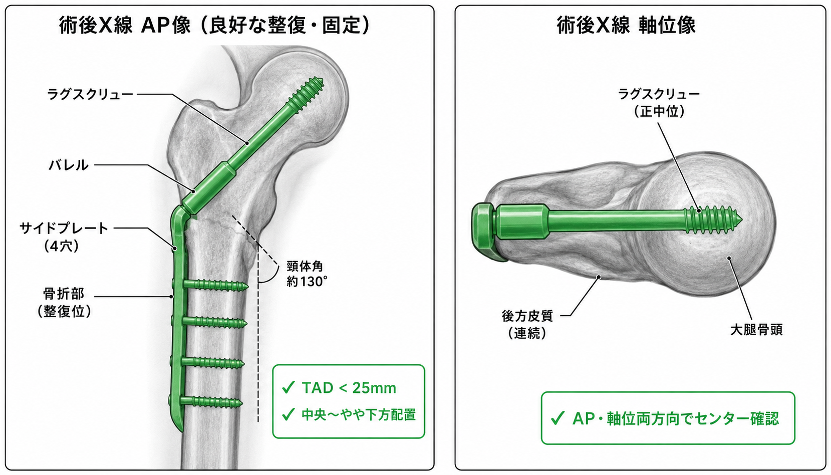 術後X線像（AP / Lateral）— 整復位・インプラント設置位置確認