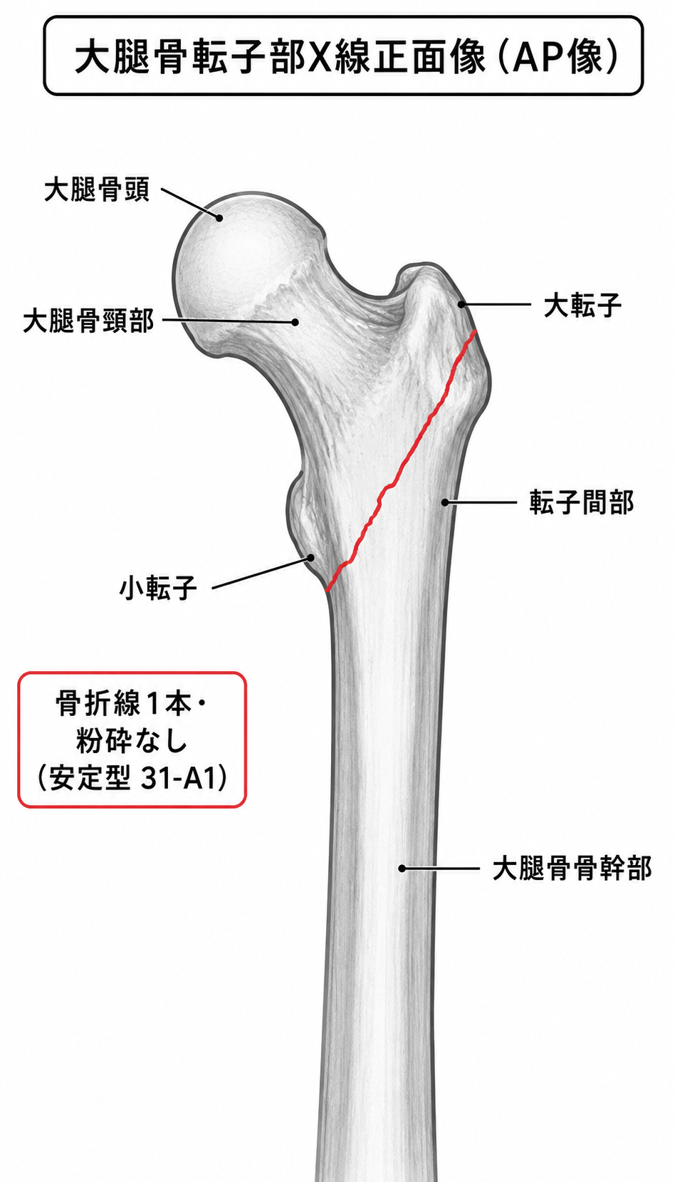 X線正面像 — 骨折線・転位・短縮の確認
